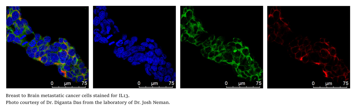 Breast to Brain metastatic cancer cells stained for IL13.